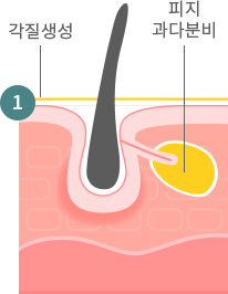여드름 발생과정1