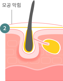 여드름 발생과정2