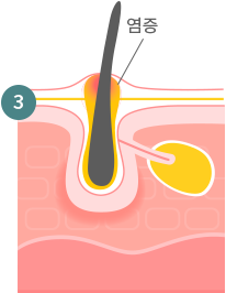 여드름 발생과정3